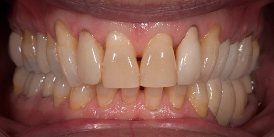 dental veneers before and after