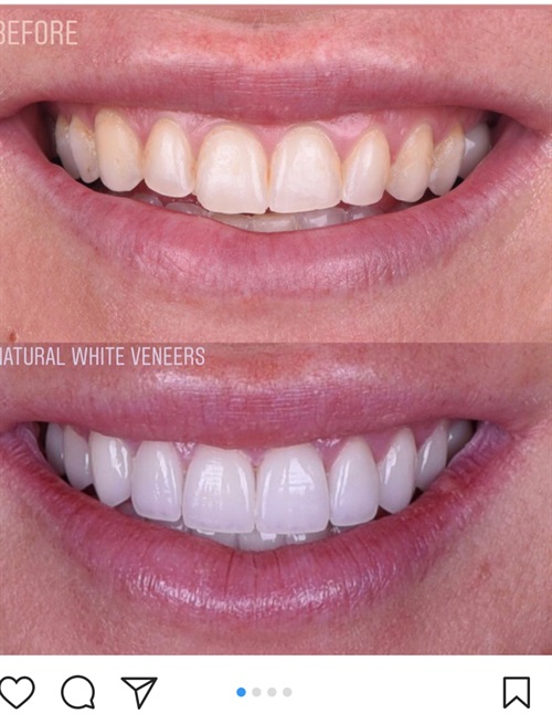 dental veneers before and after