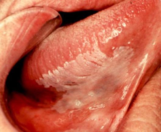 Frictional keratosis under the tongue. Frictional keratosis under the tongue.