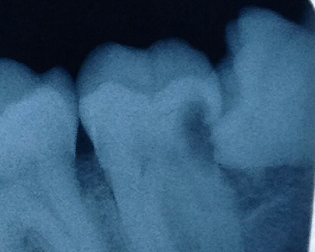 An X-ray of a wisdom tooth lying sideways against the neighboring tooth, and causing a cavity.