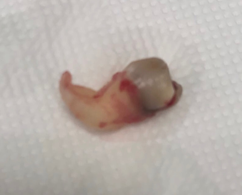 An extracted wisdom tooth with a bent root on a white gauze.