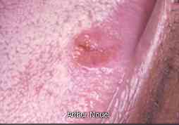 Close-up view of a tongue cancer
